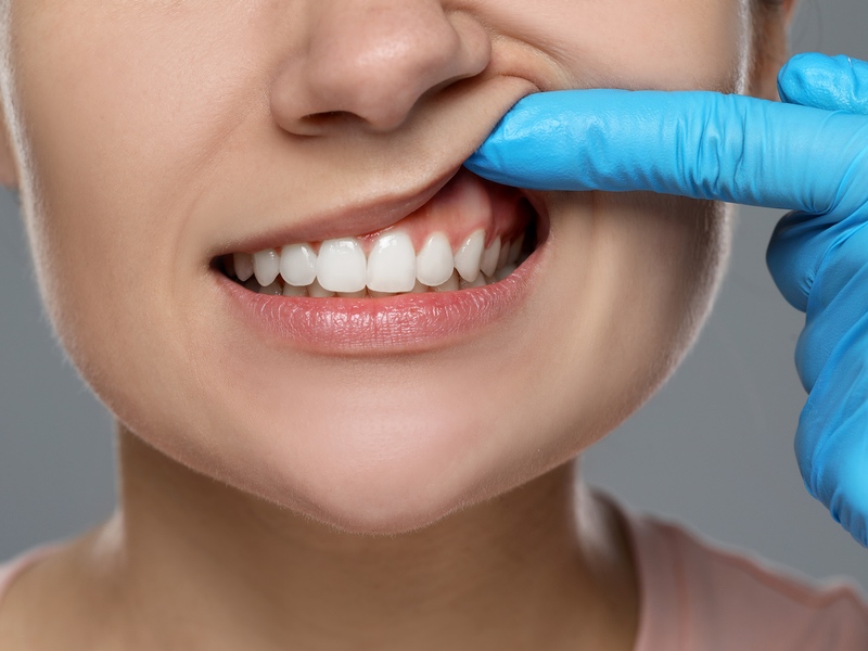 Unmasking the Threat of Gum Disease and At-Risk Individuals in Orem