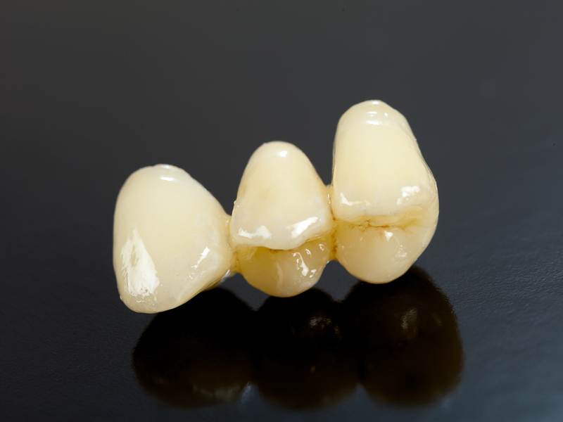 dental implant Dental bridges in Palm