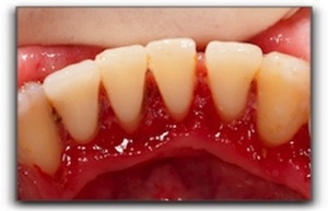 Gum Disease in Murray