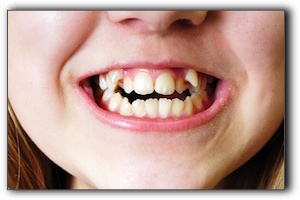 fast braces Palm Harbor