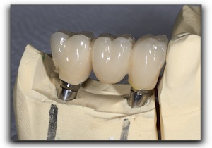 how a dental crown is made Santa Barbara