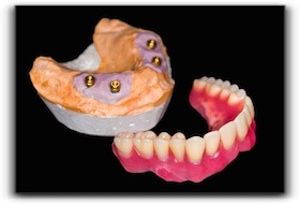 Norman tooth implant supported dentures