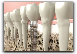 Fishers dental implants