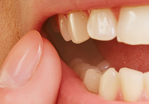 Get treatment for inflamed gums in Roy.