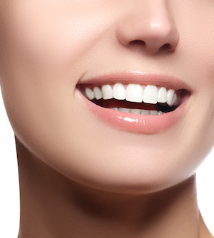 porcelain veneers Alexandria