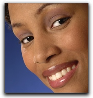 prepless veneers