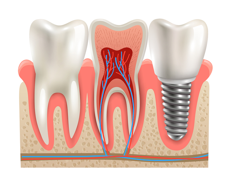 dental implants Gibsonton