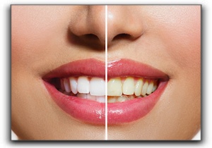 affordable teeth bleaching Lone Tree