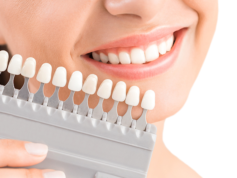 Somerton cosmetic smile makeover