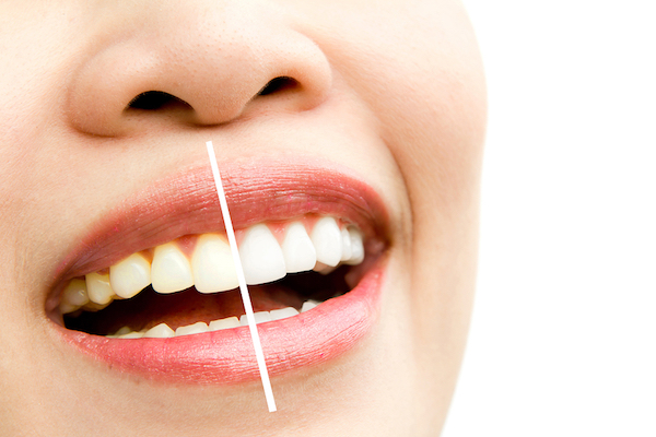 teeth whitening Marble Falls