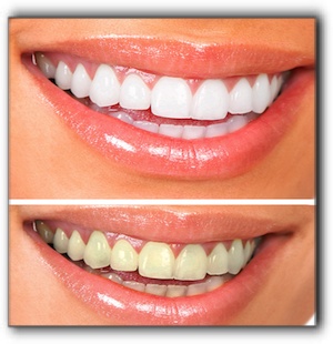 Lone Tree teeth whitening