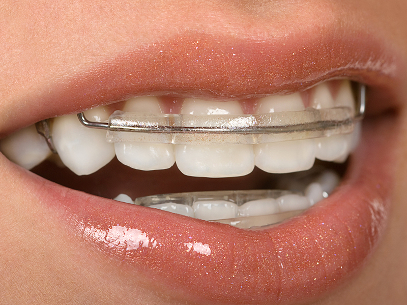 Clear Braces: Aligners & Teeth Straightening