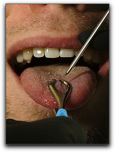 Learn about how piercings impact oral health in Friendswood.