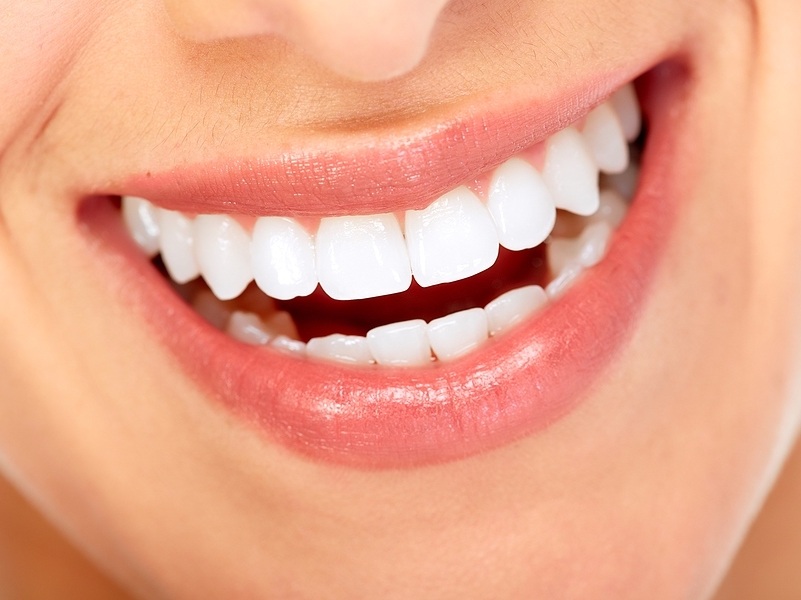 Are There Different Types of Invisible Braces? - Burlingame Smile