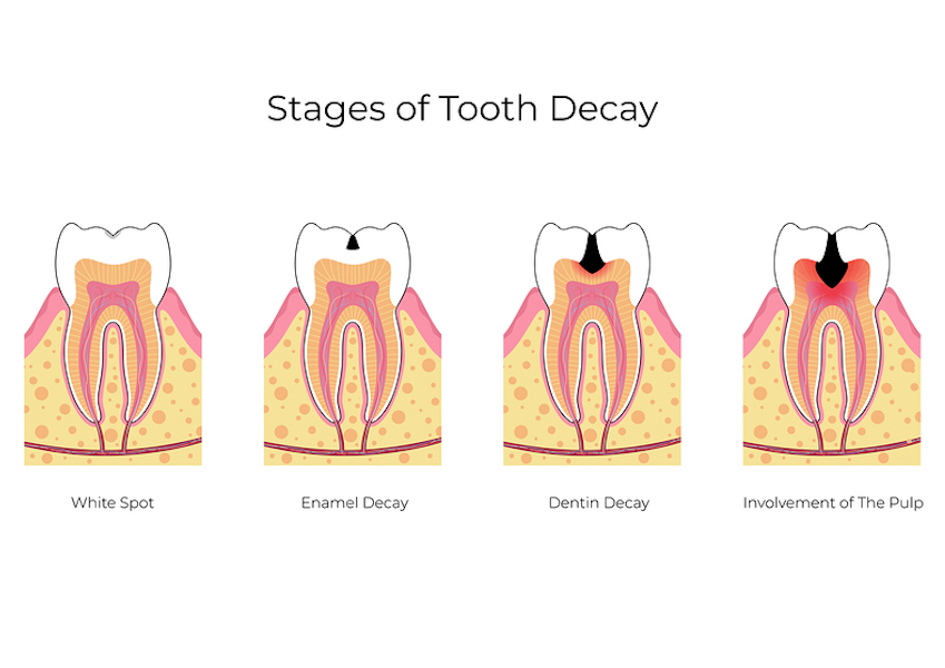 stages of a cavity Charlotte